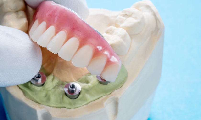 Common Myths About Dental Implants Debunked – Telegraph